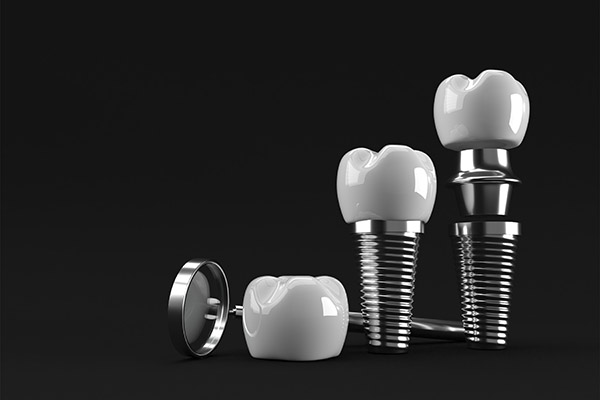 An Implant Dentist Explains the Parts Used in the Procedure from Metro Smiles Dental in Forest Hills, NY