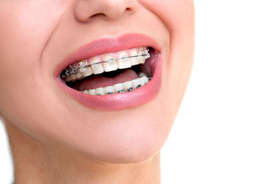 What To Expect When Getting Dental Braces