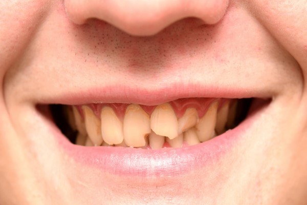 Chipped Tooth: Causes And Treatment Options