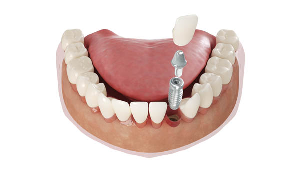 How Dental Implants Compare To Natural Teeth