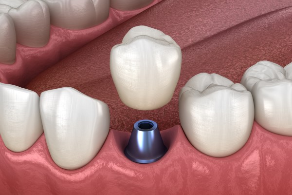 What Materials Are Used In An Implant Crown?