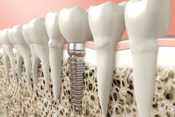 Oral Surgery Recovery Tips From An Implant Dentist