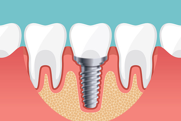 Implant Dentistry Options To Replace a Single Missing Tooth from Metro Smiles Dental in Forest Hills, NY