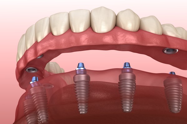 Oral Hygiene When Living With Implant Supported Dentures