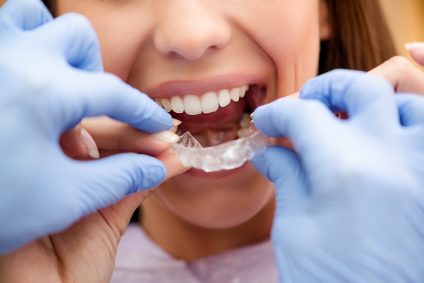 How Does Clear Aligner Treatment Feel?