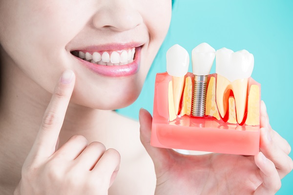 Implant Supported Dentures &#    ; Are There Other Options?