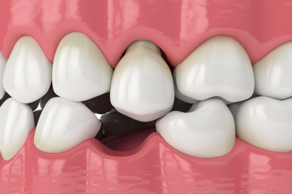 Tips For Choosing The Best Option For Replacing A Missing Tooth