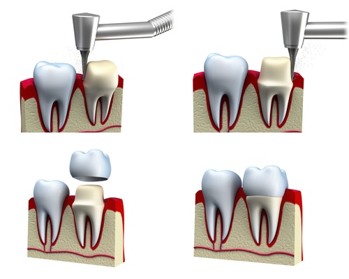 Visit Our Restorative Dentistry Office If You Damage Your Dental Crown