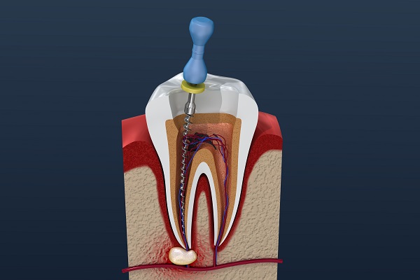 How Is A Root Canal Performed?