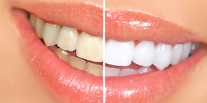 UV Lighting: Does it Work for Teeth Whitening? - Metro Smiles